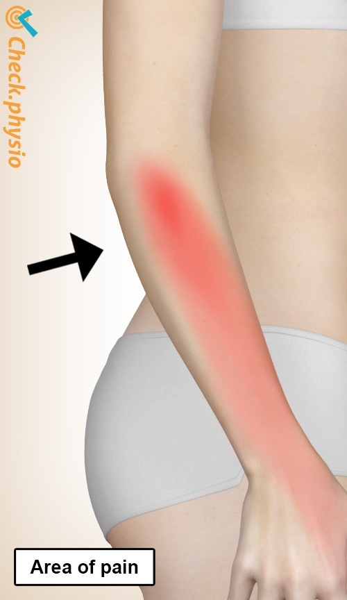 arm radial tunnel syndrome location