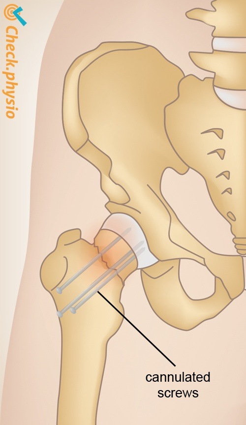 hip fracture screw fixation