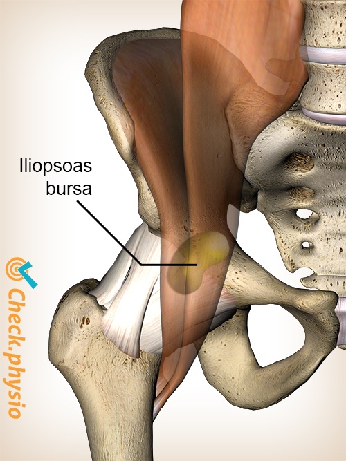 hip iliopsoas bursa bursitis