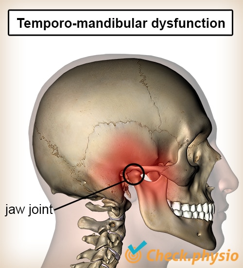 Jaw disc dysfunction Physio Check