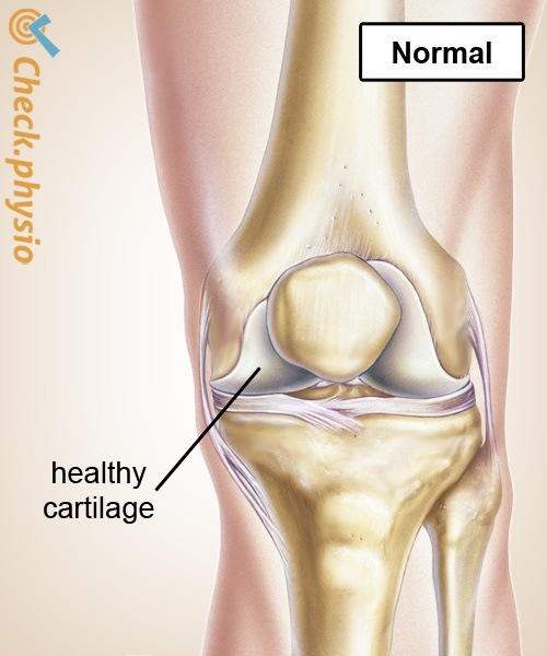 knee osteoarthritis healthy cartilage