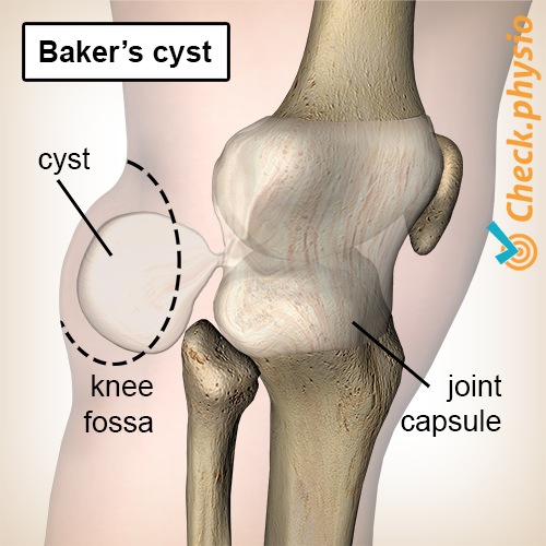 knee bakers popliteal cyst