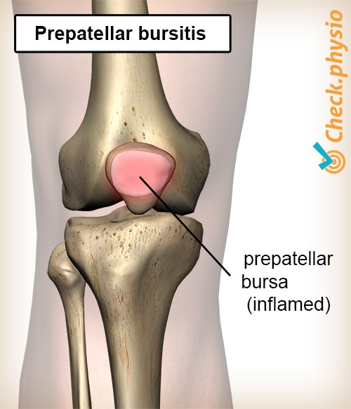 knee prepatellar bursitis inflamed bursa kneecap patella