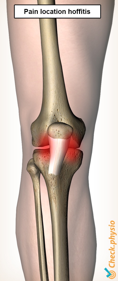 knee hoffitis pain location