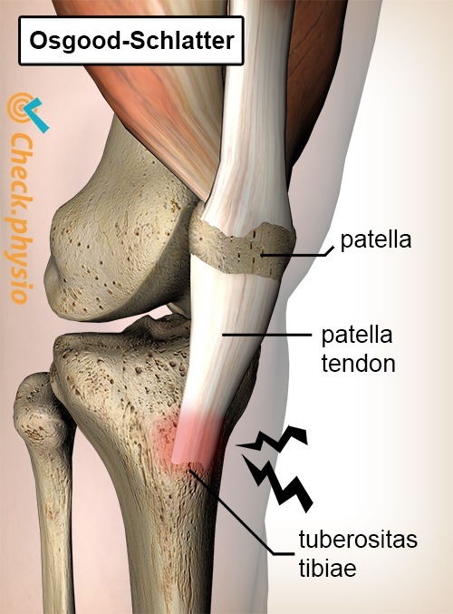 knee osgood schlatter pain patella tendon