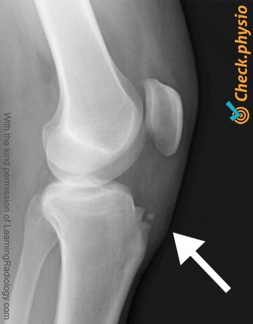 knee osgood schlatter x-ray