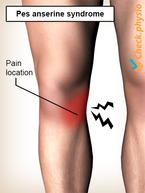 knee pes anserine syndrome pain location