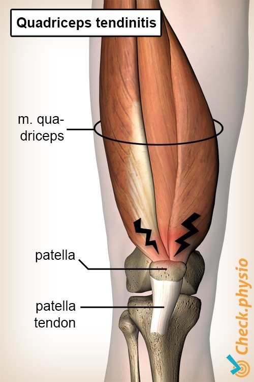 knee quadriceps tendinitis anatomy