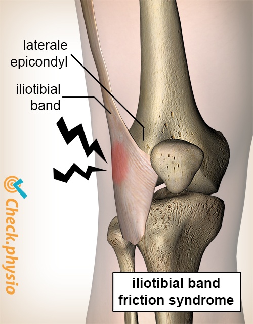 Iliotibial band syndrome Physio Check