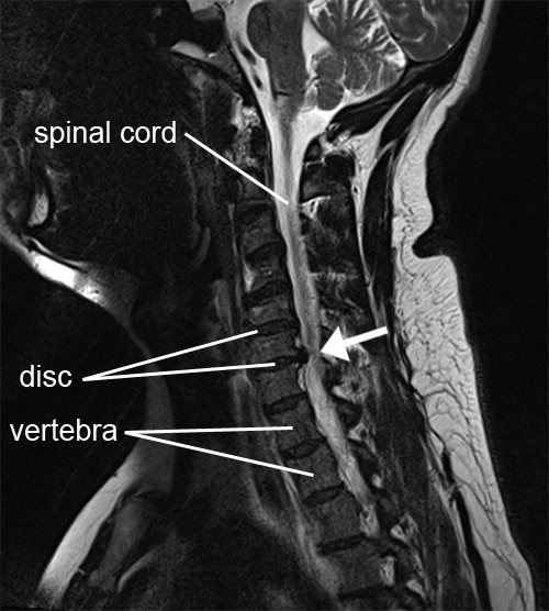 Cervical Radiculopathy Physio Check