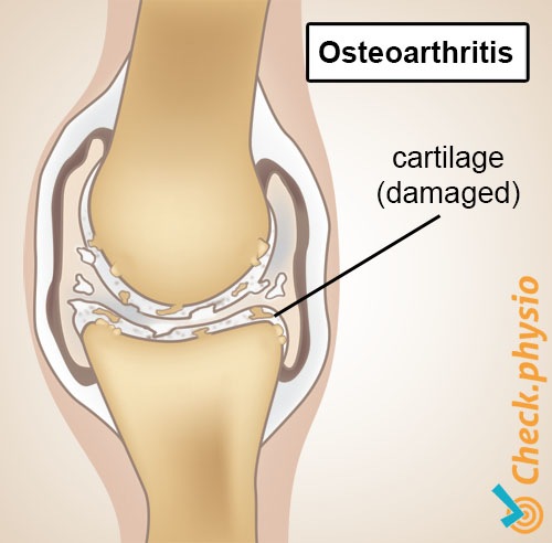 osteoarthritis anatomy degeneration