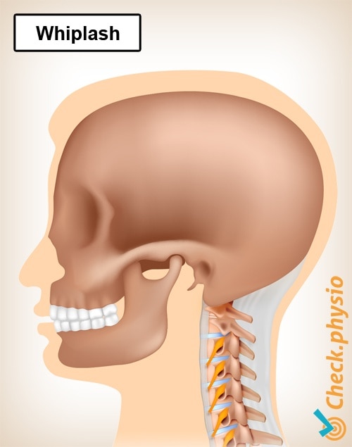 neck whiplash pain