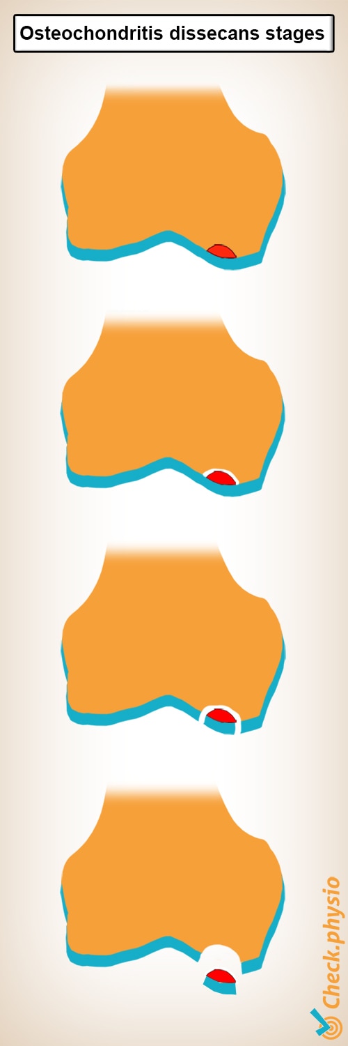 osteochondritis dissecans stages cartilage