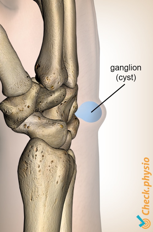 wrist ganglion cyst anatomy