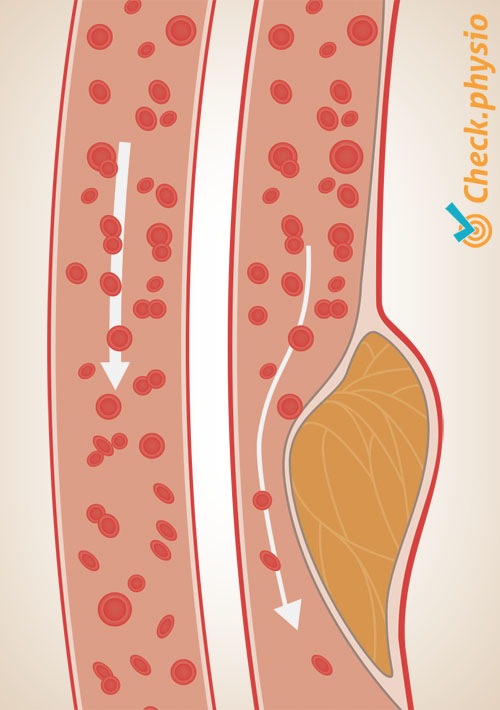 arteriosclerosis artery hardening of arteries