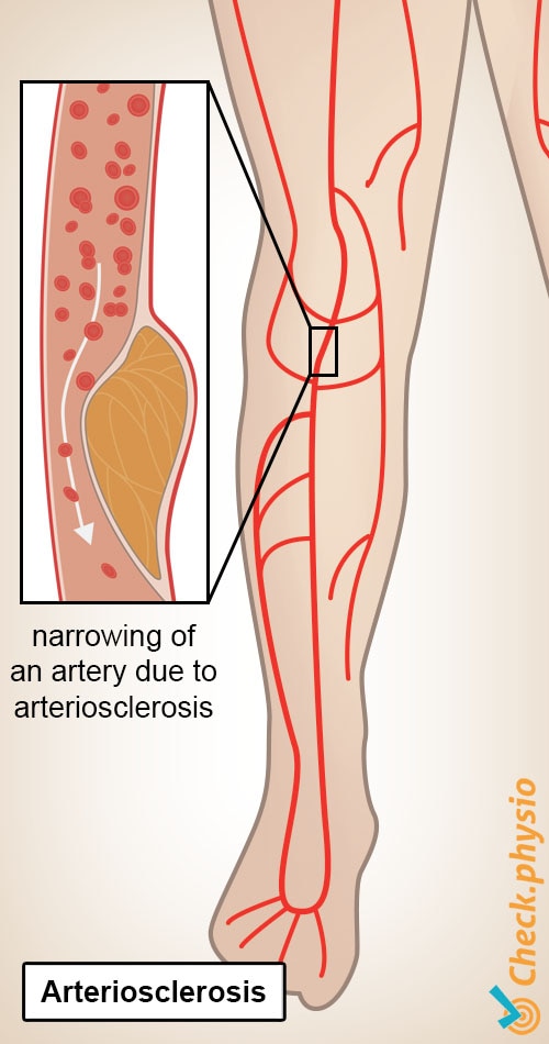 leg shop window legs intermittent claudication plaque formation