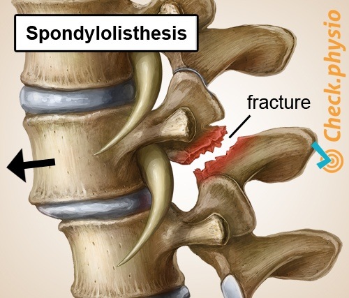 back specific low back pain spondylolisthesis shifted vertebra