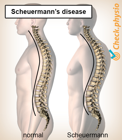 back scheuermanns disease posture spine spinal column convex kyphosis