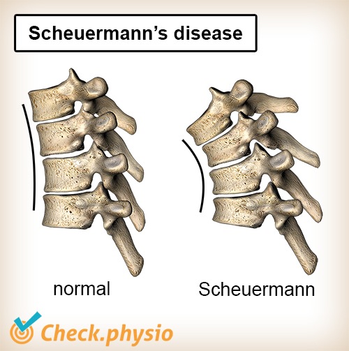 back scheuermanns disease posture spine spinal column normal kyphosis convex anatomy wedge shaped
