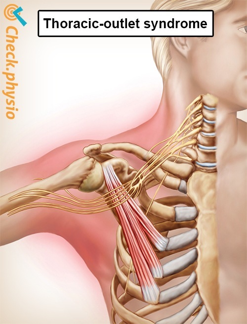 shoulder arm hand thoracic outlet syndrome anatomy
