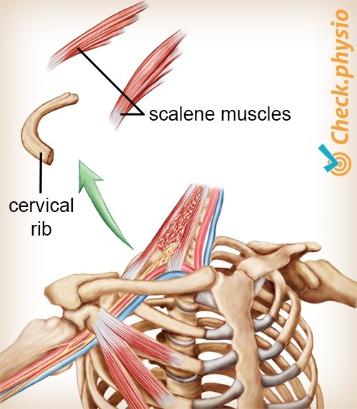 shoulder arm hand TOS thoracic outlet syndrome cervical rib