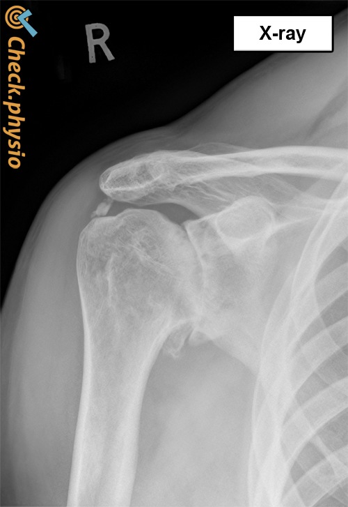 shoulder osteoarthritis x-ray