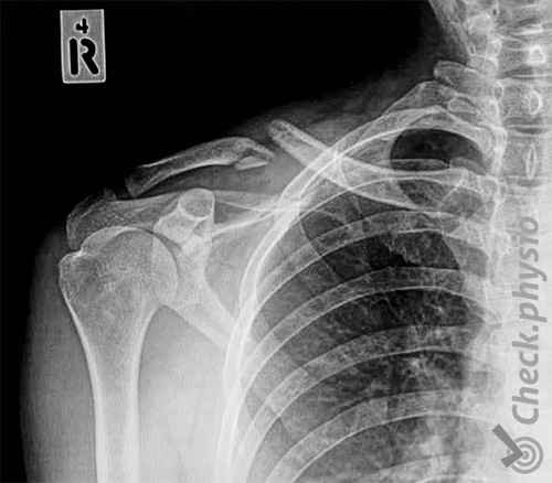 shoulder clavicula fracture broken collar bone x-ray