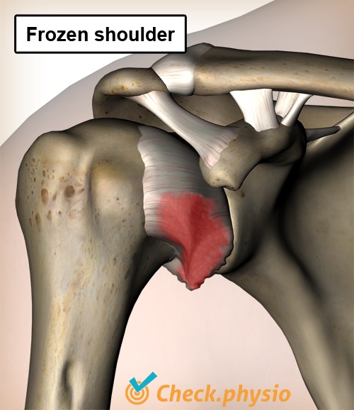 shoulder frozen shoulder