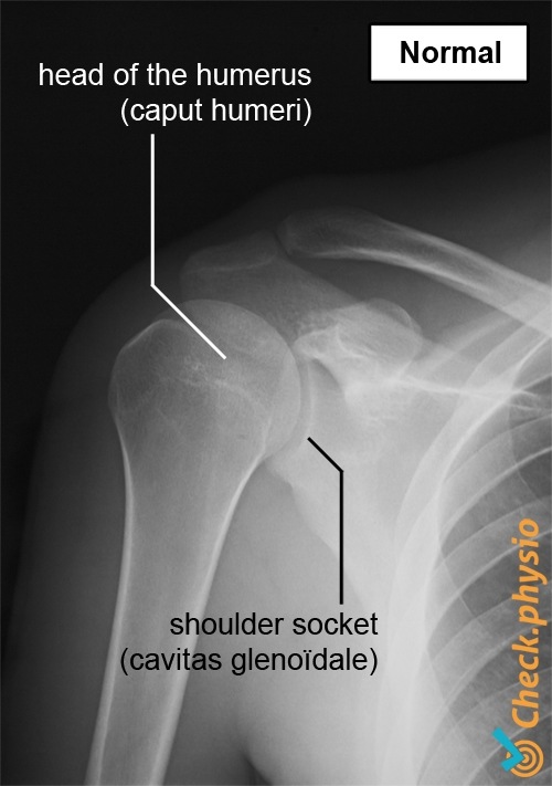 shoulder x-ray normal