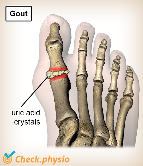 toe gout uric acid crystals