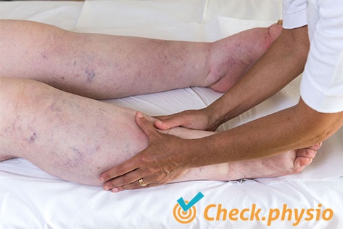 legs lymphedema lymph edema