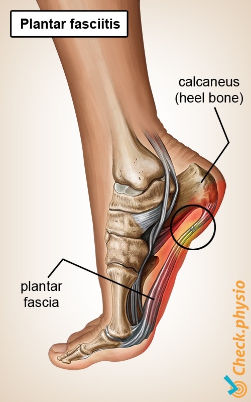 Bone spur plantar deals aspect of calcaneus
