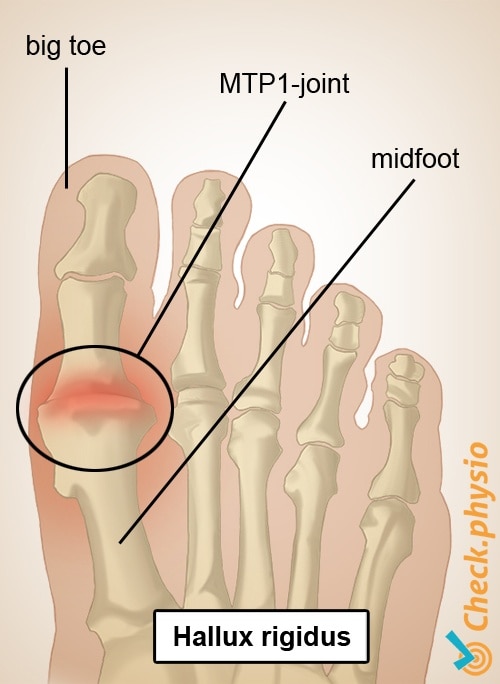 foot hallux rigidus big toe first MTP joint