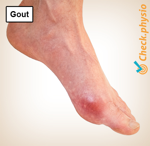 foot gout toe red swelling tophi