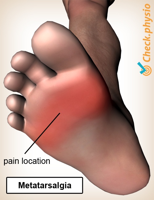 foot metatarsalgia pain location