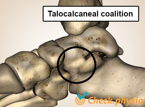 foot talocalcaneal coalition