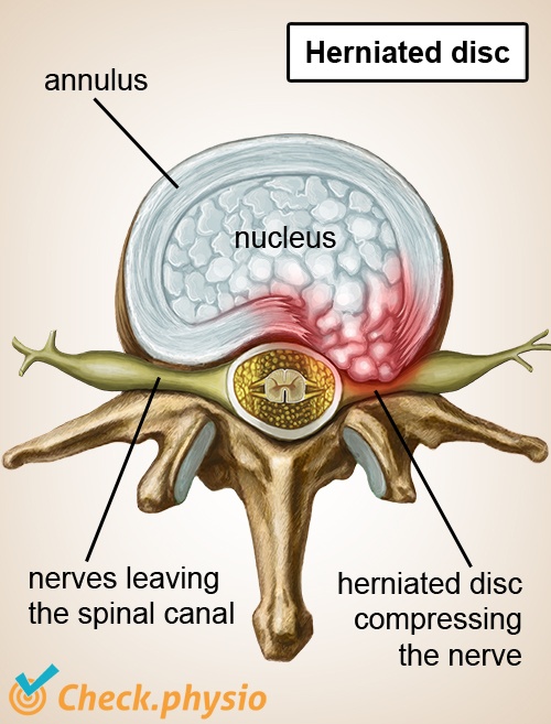spinal column spine vertebra intervertebral disc hernia nerves