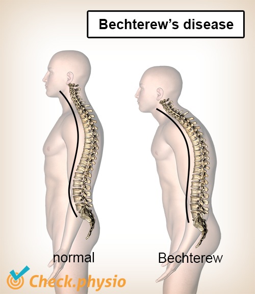 bechterews disease kyphosis convex back
