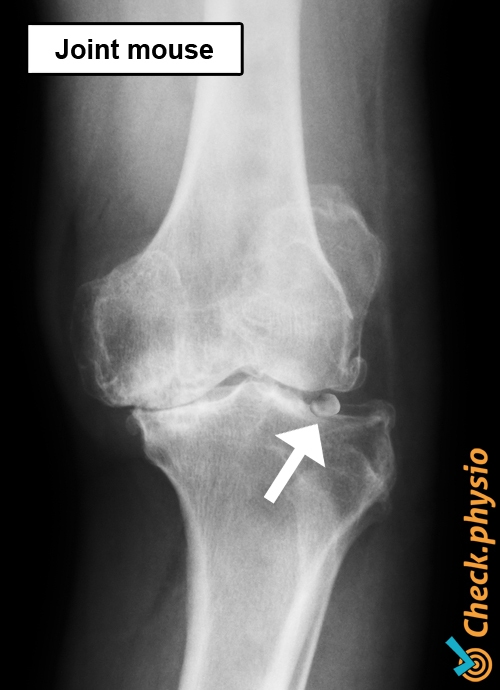 corpus liberum knee x-ray