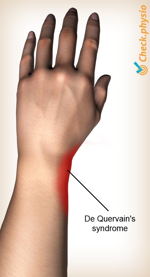 arm de Quervains disease location