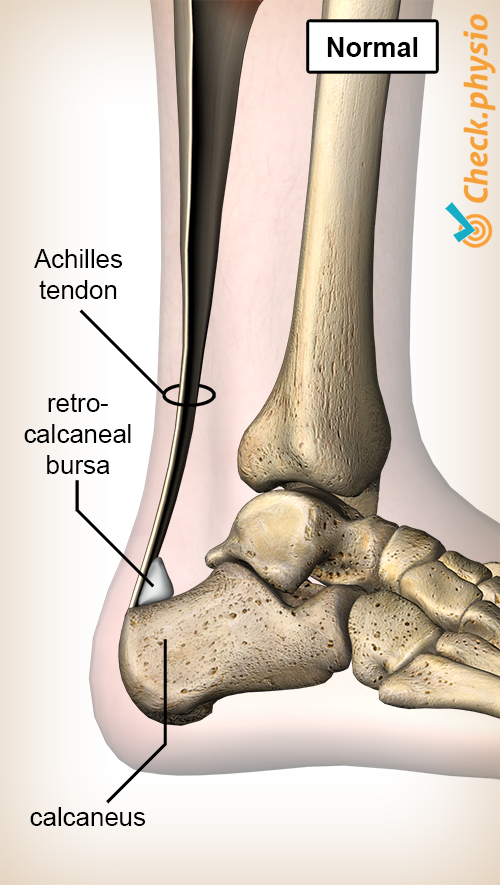 ankle achilles tendon retrocalcaneal bursa calcaneus heel bone