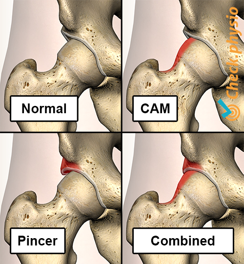 hip femoroacetabular impingement fai types