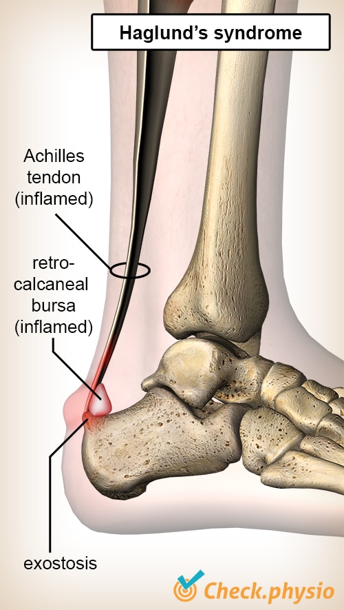 ankle Haglund syndrome achilles tendon retrocalcaneal bursa heel bone calcaneus