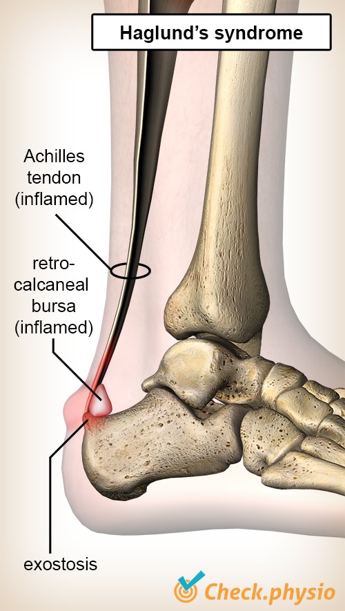 ankle haglunds syndrome achilles tendon retrocalcaneal bursa heel bone calcaneus