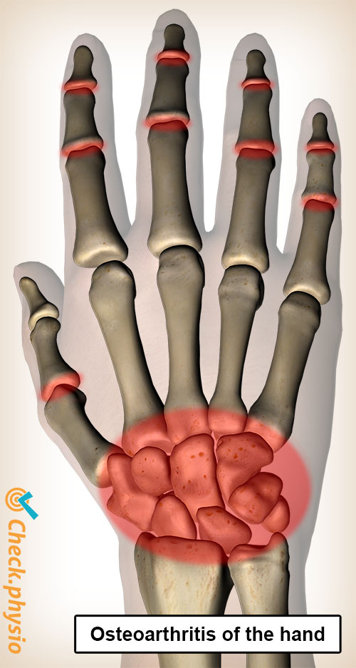 hand osteoarthritis pain locations