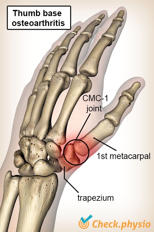 hand thumb base osteoarthritis os trapezium bone metacarpal I CMC 1 joint