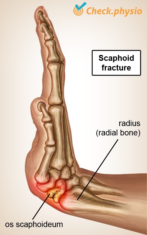 hand scaphoid fracture