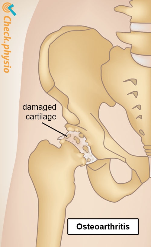 hip osteoarthritis