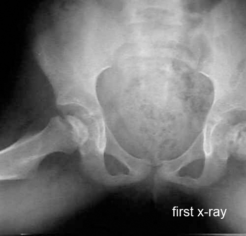 hip legg calve perthes age 6