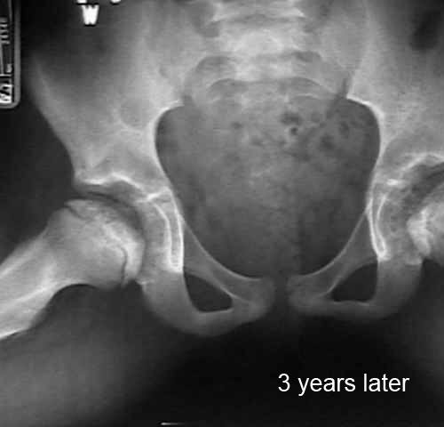 hip legg calve perthes age 9